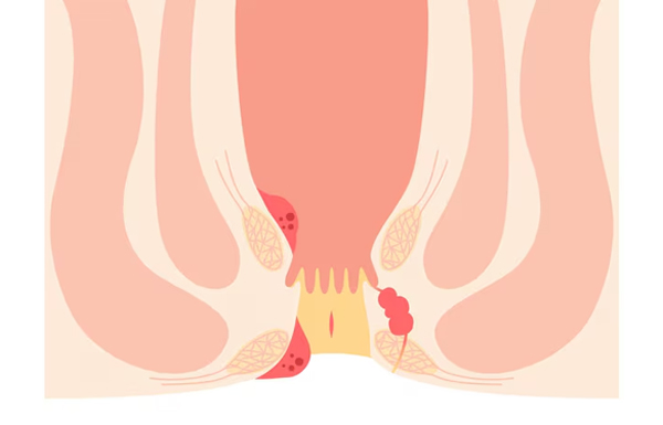 Anal Fissure