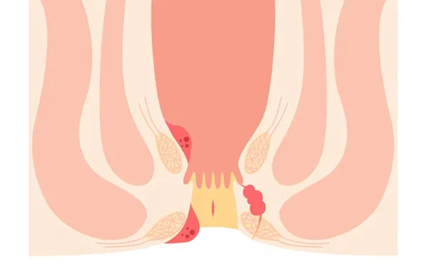 Anal Fissure
