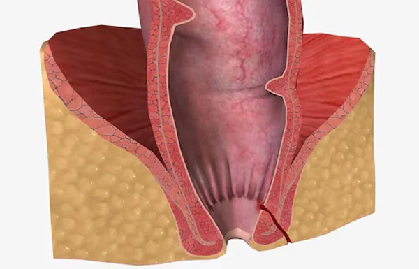 Anal Fistula