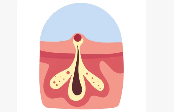 Pilonidal Sinus